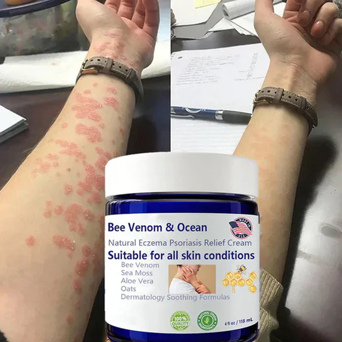 Bee Venom & Ocean Natural Eczema Psoriasis Relief Cream β Soothing & Healing Formula πΏπ